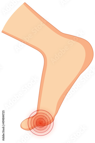 Hallux valgus types on white background