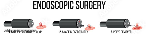 Diagram showing endoscopic surgery