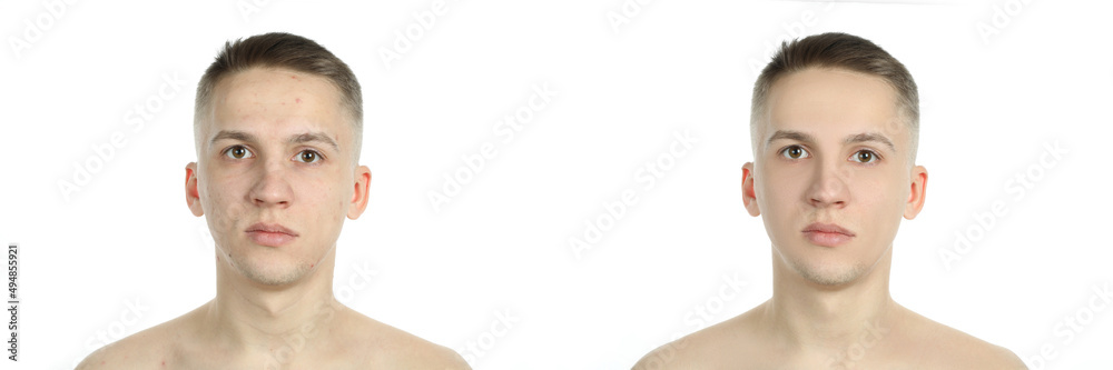 Obraz premium Before and after effect of skin care procedures, isolated on white background