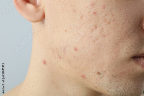 Obraz na plátne Concept of skin care with problem skin, close up