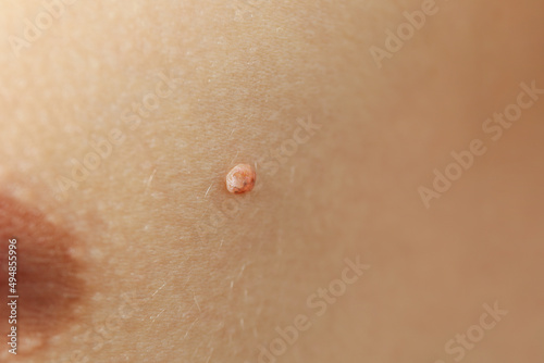 Concept of body care with skin with papilloma or mole