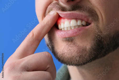 Man with gum inflammation o...