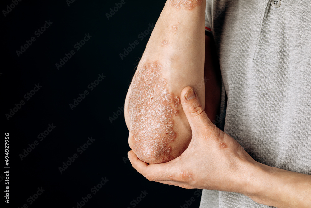 Naklejka premium Acute psoriasis on the elbows is an autoimmune incurable dermatological skin disease. A large red, inflamed, flaky rash on the elbows. Joints affected by psoriatic arthritis