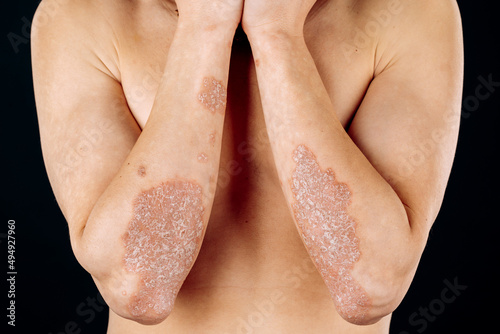 Acute psoriasis on the elbows is an autoimmune incurable dermatological skin disease. A large red, inflamed, flaky rash on the elbows. Joints affected by psoriatic arthritis