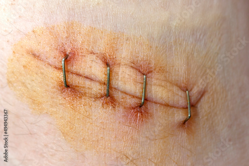 Surgical staples for sutures to close skin. First aid for a deep cut on the skin. Antiseptic and scar treatment