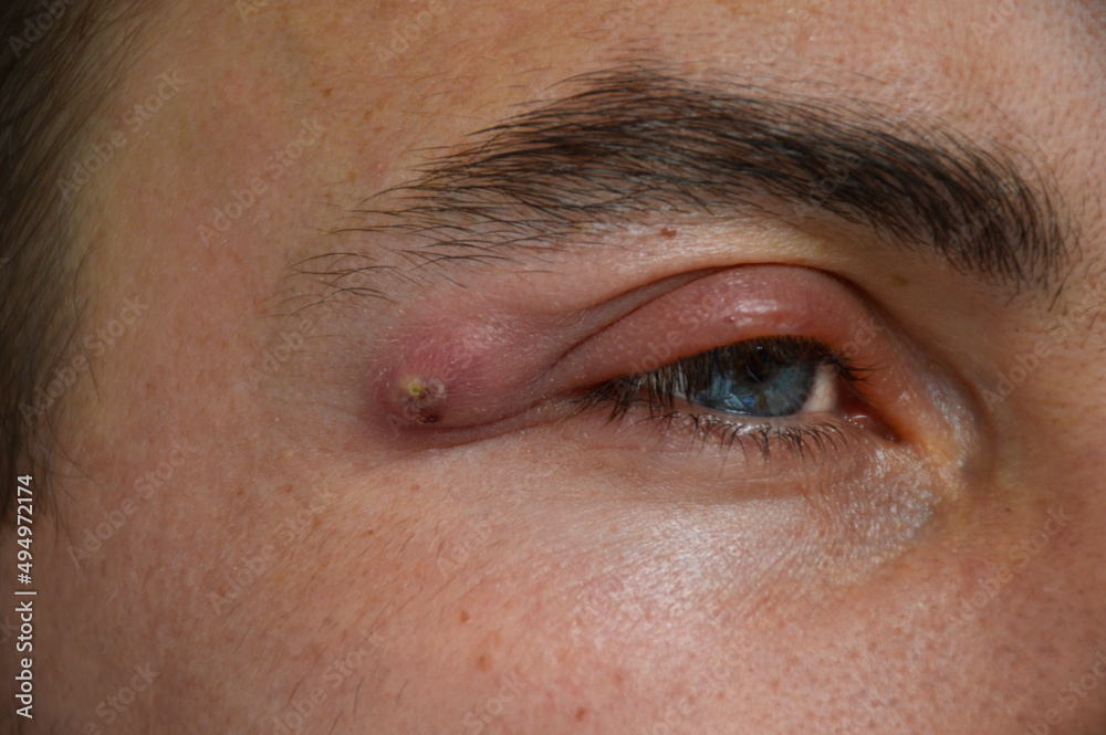 boil a strong purulent abscess in a man near the eye. swelling from