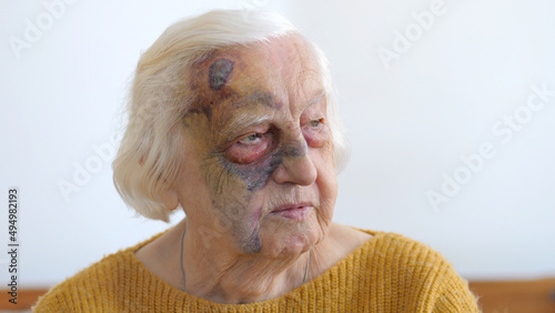 Old woman with bruises on the face. Bruises caused by dizziness, falling over and hitting with head on the floor. Blood from the head area moved to the eye and to the face