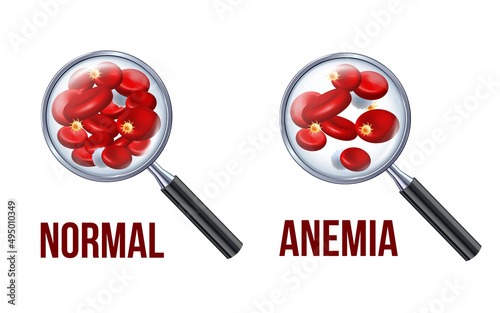 Iron deficiency anemia.The difference of Anemia amount of red blood cell and normal.