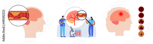 Brain stroke ishemic