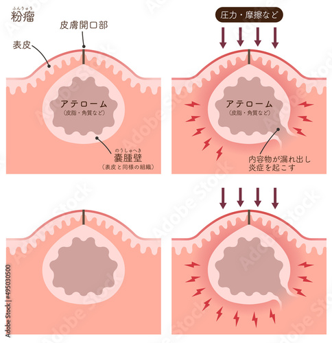 粉瘤・炎症性粉瘤・アテローム・できもの・炎症のイラスト