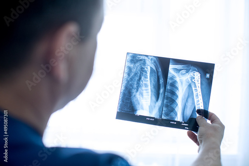 doctor holding x-ray picture of arm shoulder after surgery 