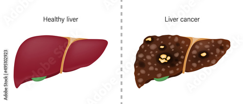 Comparison of the difference between normal liver and liver cancer. Liver disease for medical education and science.