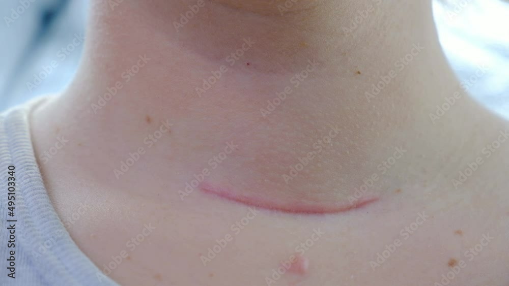 Girl's neck in motion close-up. Mark on the neck after surgery. Postoperative new scar.
removal of the thyroid gland. enlarged cervical lymph nodes, hyperthyroidism. Concept: Endocrinology Treatments Girl's neck in motion close-up. Mark on the neck after surgery. Postoperative new scar.
removal of the thyroid gland. enlarged cervical lymph nodes, hyperthyroidism. Concept: Endocrinology Treatments