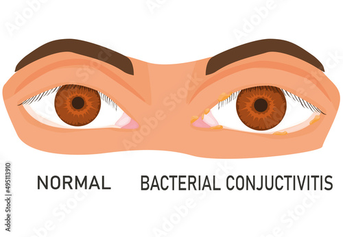 illustration of eyes with bacterial conjunctivitis. eye diseases. eye irritation. flat vector. healthy and diseased eye. isolated on white background. eyesight.