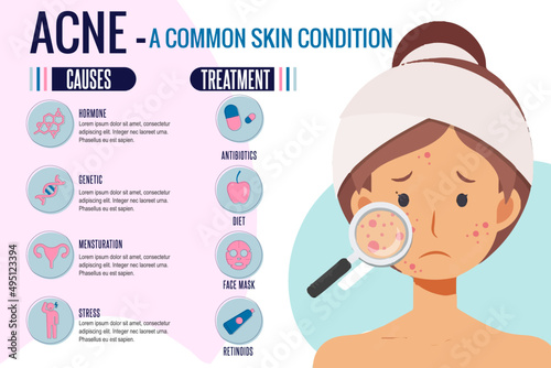 Acne causes and treatment skin problems infographics templet