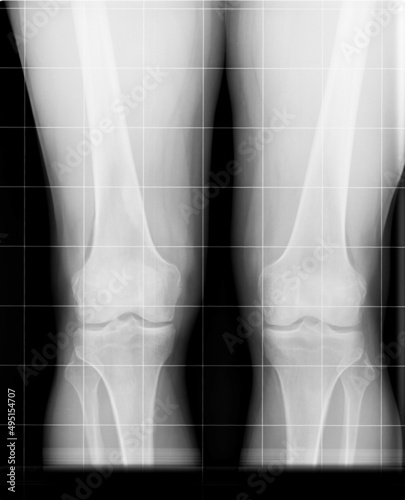 Foto Radiografia rodillas rx