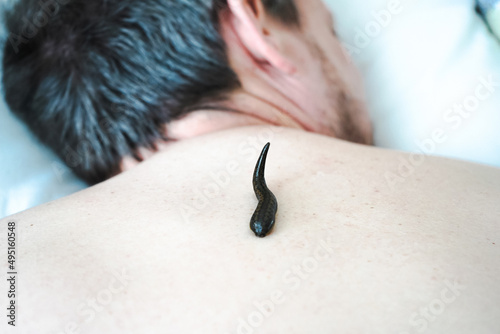 A leech sucks blood on the back of a patient in a hirudotherapy salon photo