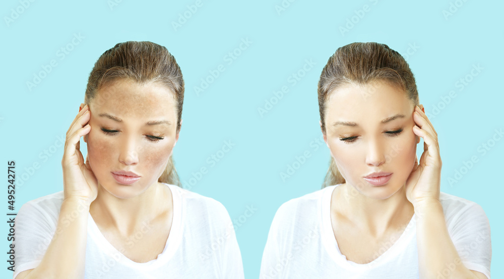 Dark spots, freckles,hyperpigmentation(melasma or chloasma),concept - skin lightening, skin whitening, fruit acids,AHA, Skin Brightening. Dark spots, freckles,hyperpigmentation(melasma or chloasma),concept - skin lightening, skin whitening, fruit acids,AHA, Skin Brightening.
