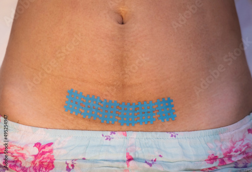 Taping a kinesiology tape on a scar after a caesarean section. Recovery after childbirth.