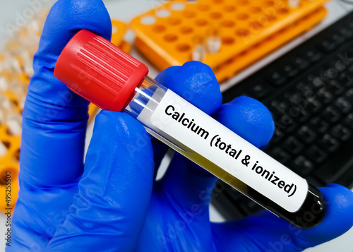 Blood sample for calcium (total and ionized) test. bone disease.
