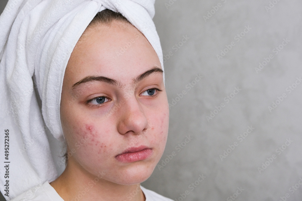 teenage girl with acne on her face. teenage girl with acne on her face.