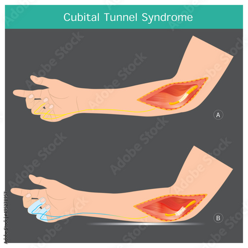 Cubital Tunnel Syndrome. A condition that involves pressure or stretching of the ulnar nerve in arms which can cause numbness or tingling in the ring and small fingers.