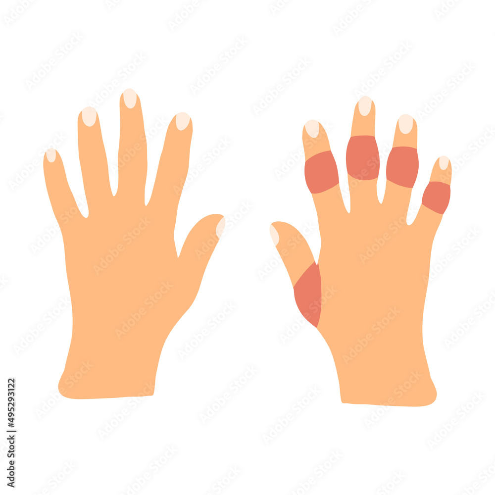 Hands with rheumatoid arthritis disease in cartoon flat style. Vector illustration of sick stiffness swollen joints. Human disorder Hands with rheumatoid arthritis disease in cartoon flat style. Vector illustration of sick stiffness swollen joints. Human disorder