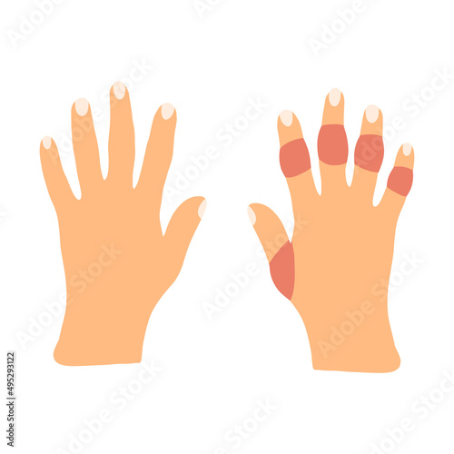 Hands with rheumatoid arthritis disease in cartoon flat style. Vector illustration of sick stiffness swollen joints. Human disorder
