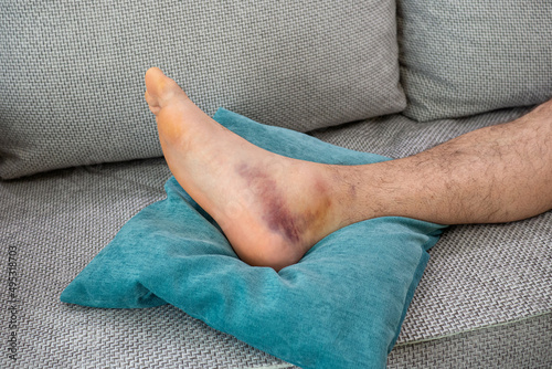 Ankle injury with dislocation and sprains. Fracture or Leg sprain injury of young sports man. 