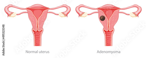 Adenomyoma Adenomyosis Human anatomy Female Sick and normal reproductive system organs. Location scheme Cross section uterus, cervix, ovary, fallopian tube icon. Vector illustration isolated on white