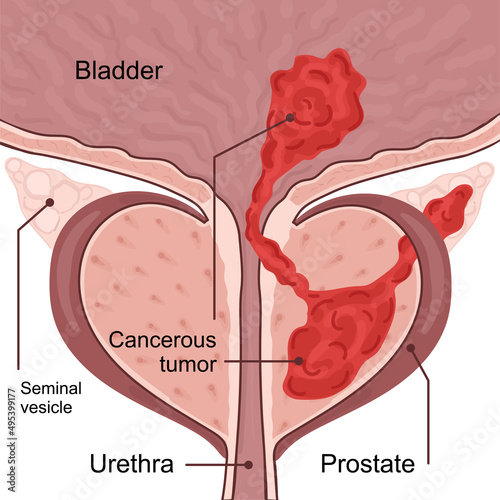 Medical diagram of 4 stage of prostate cancer. tumor grows and penetrates into neighboring organs and tissues. photo