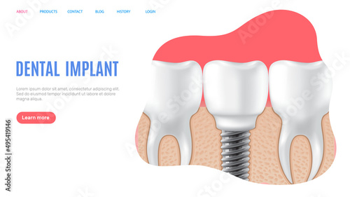 Human jaw with normal teeth and prosthesis above dental implant structure. Tooth after dental procedure. Surgical implant in oral cavity. Treatment, dentistry, oral care. Healthy tooth in human gum