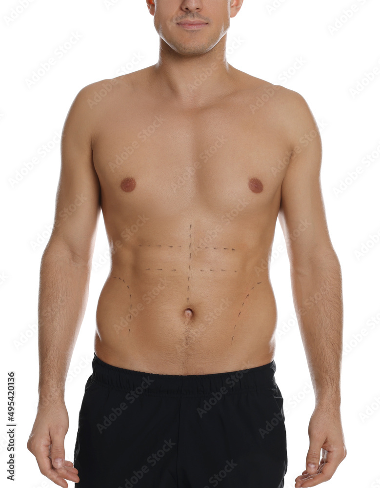 Fit man with marks on body against white background, closeup. Weight loss surgery