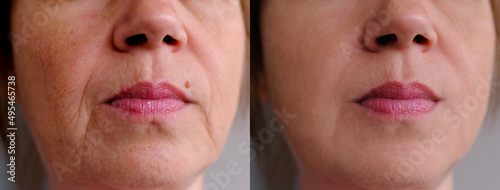 Before and after cosmetic operation. close-up of face middle-aged woman in two versions, small wrinkles on face, overhang, concept of cosmetic anti-aging procedures, facial massage, mole removal