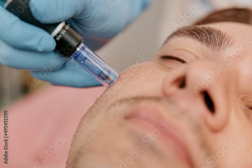 Collagen Induction Therapy Microneedling For the face of a European man close-up photo
