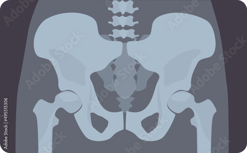 Hip Bone X-ray Illustration