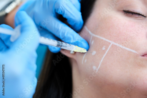 marking points for anti-bruxism treatment