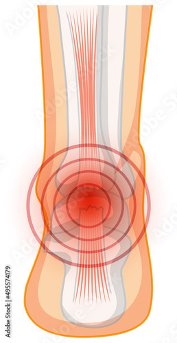 Achilles tendo rupture on white background