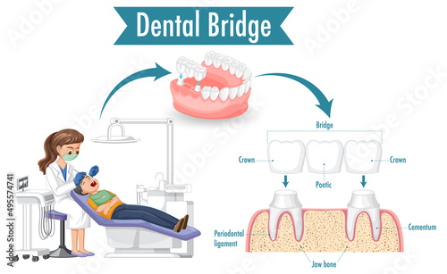 Infographic of human in dental bridge on white background