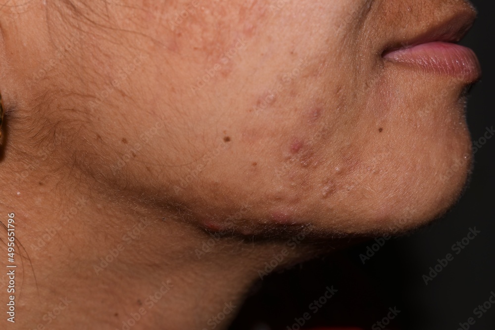 Pimples, Dark Spots and open pores on face closeup background Pimples, Dark Spots and open pores on face closeup background