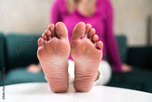 Close up of woman legs with callus on it. Feet with corn caused of heels. Need of pedicure 