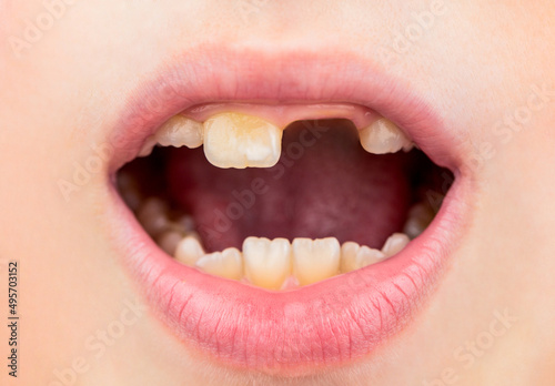 Bad teeth child. Portrait boy with bad teeth. Child smile and show her crowding tooth. Close up of unhealthy baby teeths. Kid patient open mouth showing cavities teeth decay