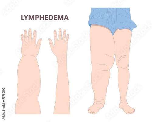 Leg edema venous syndrome Milroy Deep vein cancer swelling upper limb wrap calf ulcer meige lymph node arms hand pain cloth blood feet ankle liver kidney heart lung non Nonpitting pedal photo