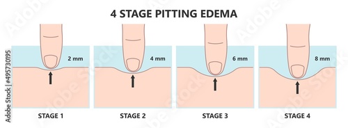 meige syndrome edema Milroy Leg venous Deep vein cancer swelling upper limb wrap calf ulcer lymph node arms hand pain cloth blood feet ankle liver kidney heart lung non Nonpitting pedal photo