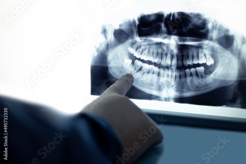 Close-up of a doctor's hand pointing to a dental x-ray photo