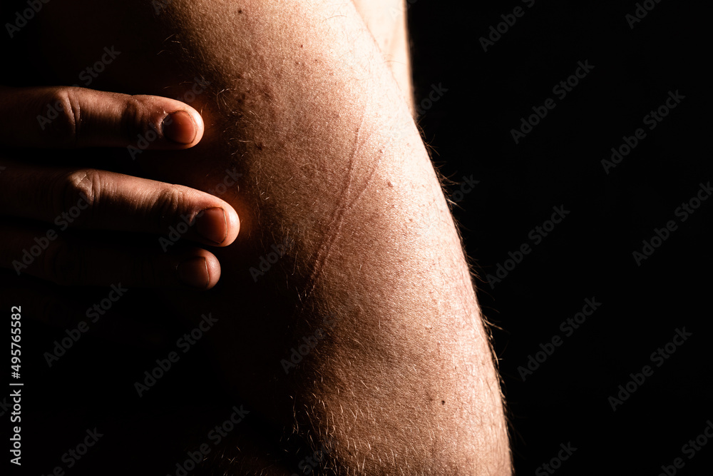 Fototapeta premium Close up of mans hand and fingers, holding himself in depression and worry, with scratch marks. 