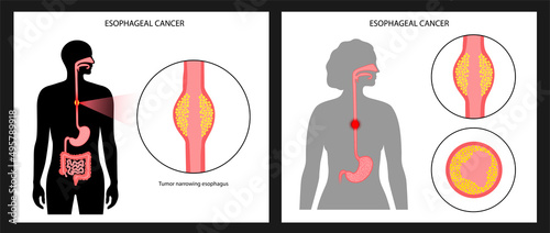 Esophageal carcinoma concept