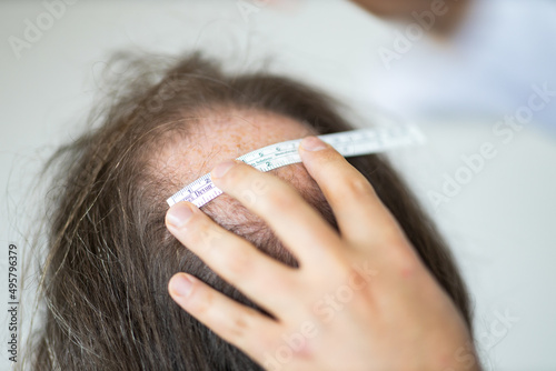Closeup of woman's hands working for hair transplant preparation on man's head photo