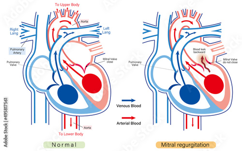 Heart with mitral regurgitation vector diagram compared with a normal heart. Simple clean design best for medical/educational websites, brochures, and flyers.