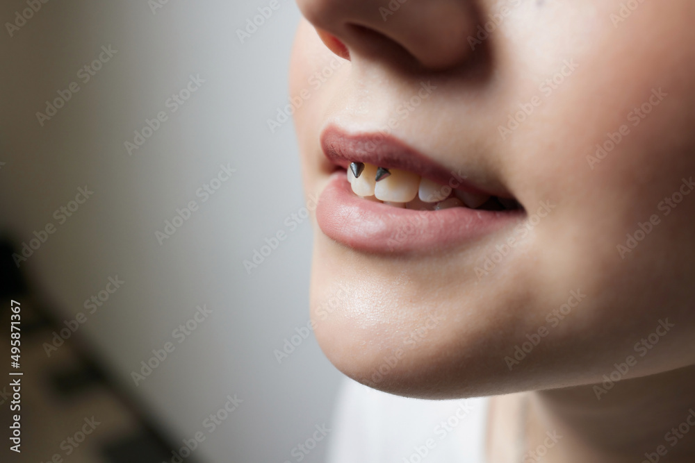 smile or frenulum piercing under the upper lip. Stock-Foto | Adobe Stock
